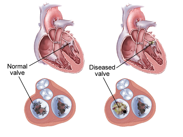 aortic-valve-disease-vejthani-hospital-jci-accredited-international