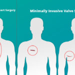 What Are The Advantages Of Minimally Invasive Heart Surgery?