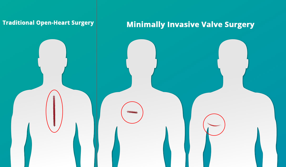 What Are The Advantages Of Minimally Invasive Heart Surgery?